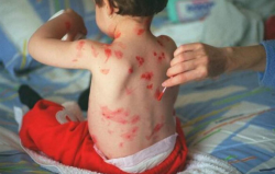 Alerta: aumentan casos de varicela en el Perú 